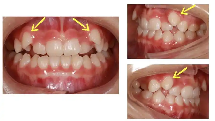 很多人的虎牙并非与其他牙齿正常排列,而是长在口角旁,造成牙齿拥挤或