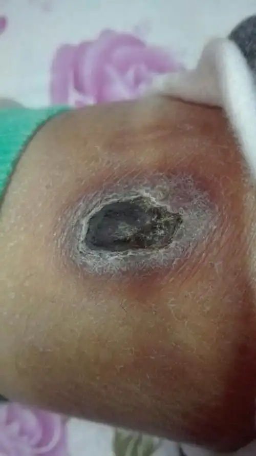 孩子腿不小心得开水烫了,都快好了,俗话说就是定嘎波(结痂)了.