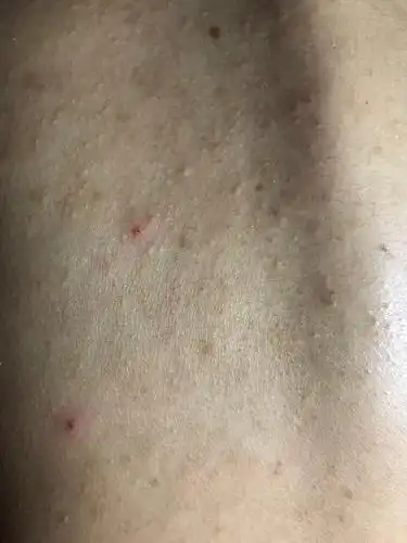 【哇靠】辣眼慎入!后背长痘你们都是怎么办的?