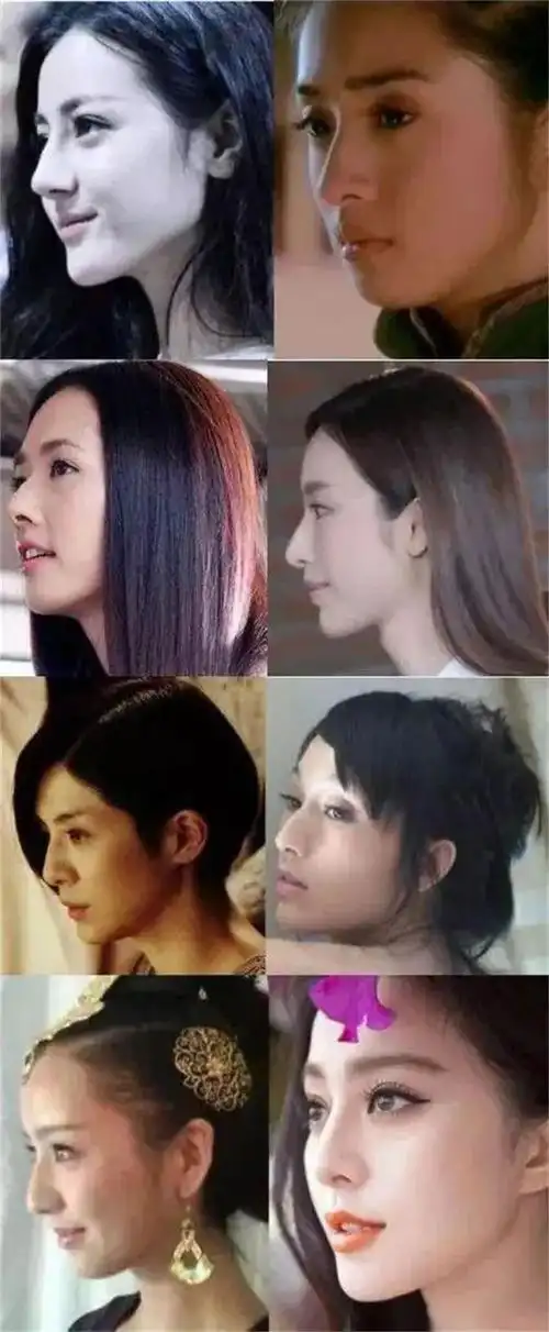 毋庸置疑重度驼峰鼻很影响颜值.