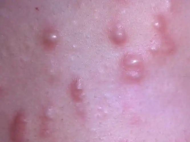 胸口长了好多小包,平时不痛不痒,出汗了偶尔会痒,想