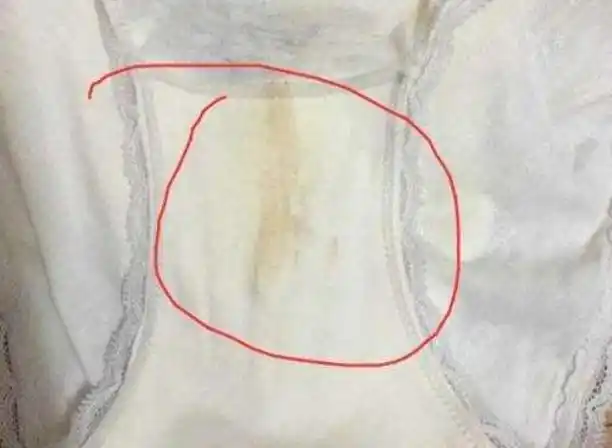 内裤是宫颈疾病的"感应器"?若出现2种颜色,尽量要注意