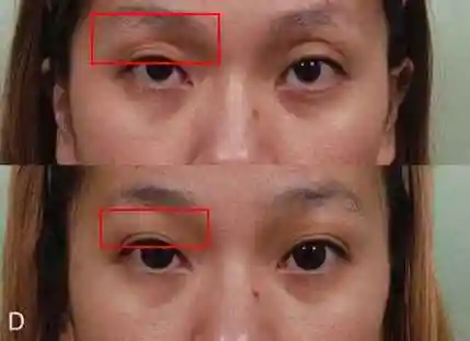 再注射到眼窝的皮下组织里,成活的移植脂肪就可以自然地将凹陷处的