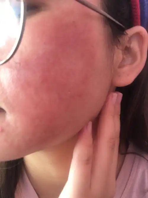 红肿瘙痒的,前几天好了,今天又怎样,是因为天气吗?