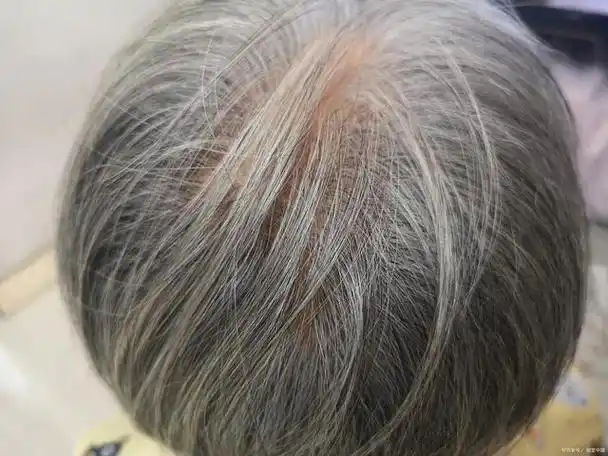 白头发突然越长越多,是人老了吗?