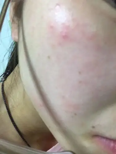 我是超级敏感性皮肤,春天脸上出现了图片上的红点,不涂水乳的时候干的