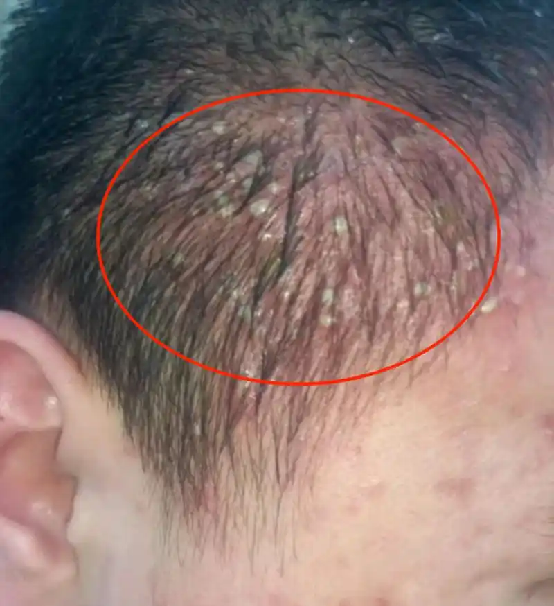头上长红疙瘩,脓疱,脓包,白脓头,伴疼痛和瘙痒感,这是毛囊炎的的