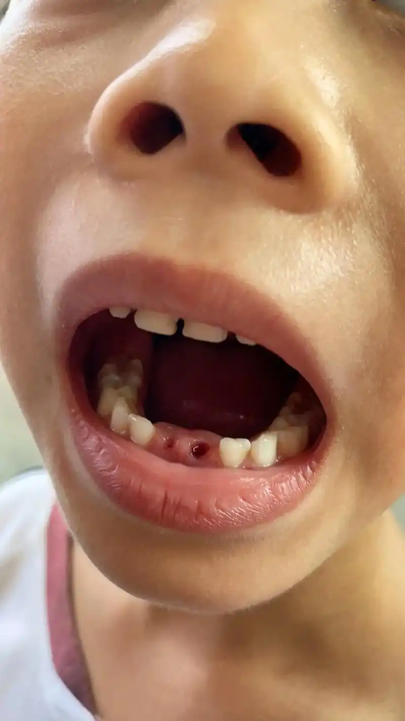 乳牙拔出来牙根这么长,会影响恒牙长出吗?我家的小男孩96 没 - 抖音