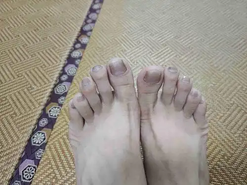请问脚趾甲颜色很深怎么回事啊,还有横纹,很多年了.女,27岁