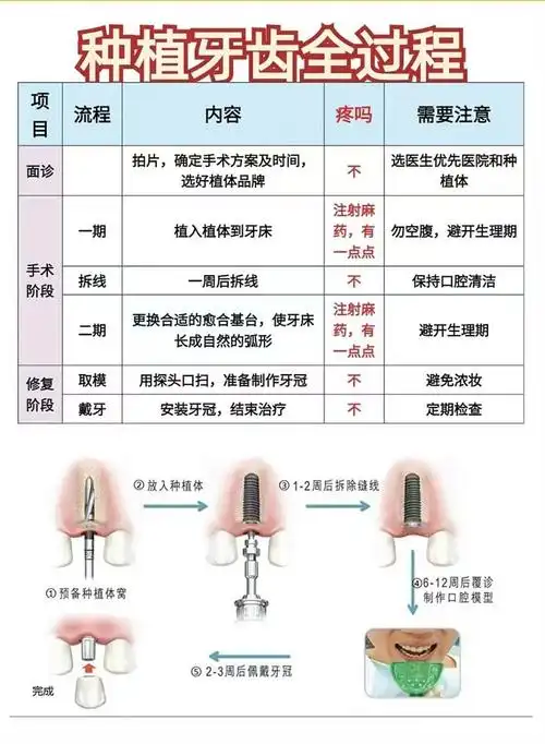 n牙齿种植目前深受各位牙友们的青睐,那么,种植牙总共分为几个步骤