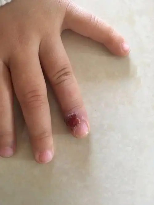 孩子手指上起泡,而后结痂,请医生朋友给看看.