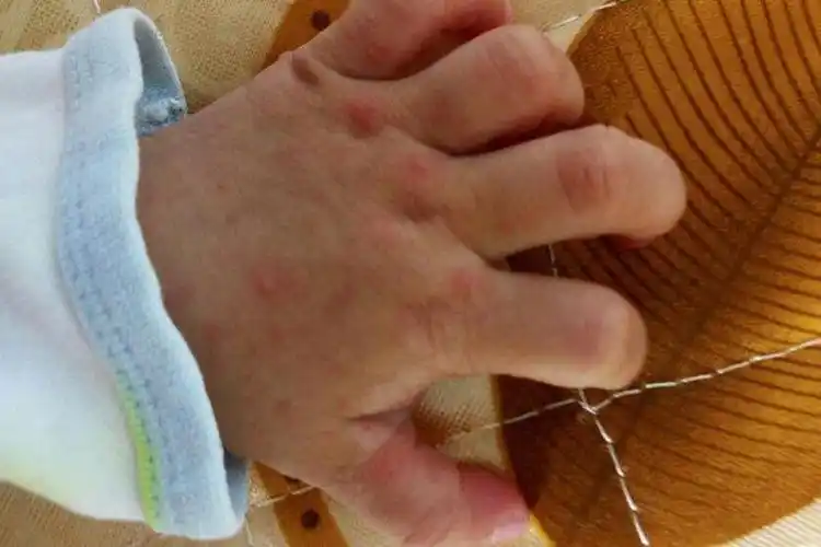 儿童手足口小红点图片_有来医生