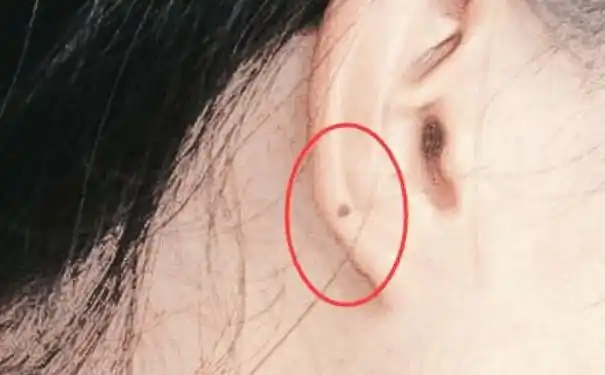 身上的5大靠山痣看看你有吗