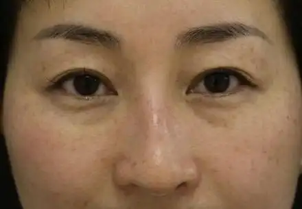 黄褐斑是长什么样的