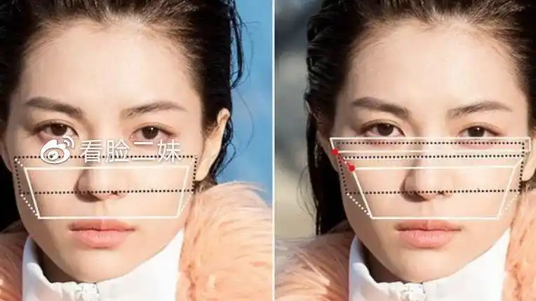 图解对比,让你三分钟知道颧骨高和颧骨外扩的区别是什么?