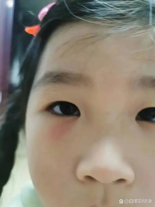 有姐妹知道孩子眼睛下面起的这疙瘩怎么回事 宝宝不到五周岁,最近一哭