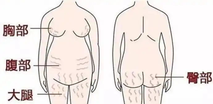 生过小孩的肚子,十之八九有这类的特征