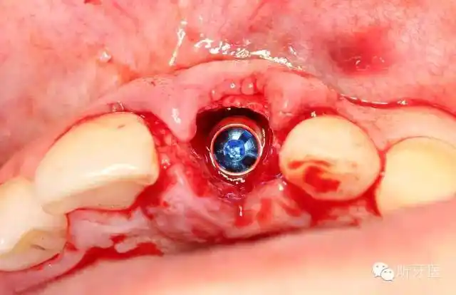 前牙单颗即刻种植及美学修复