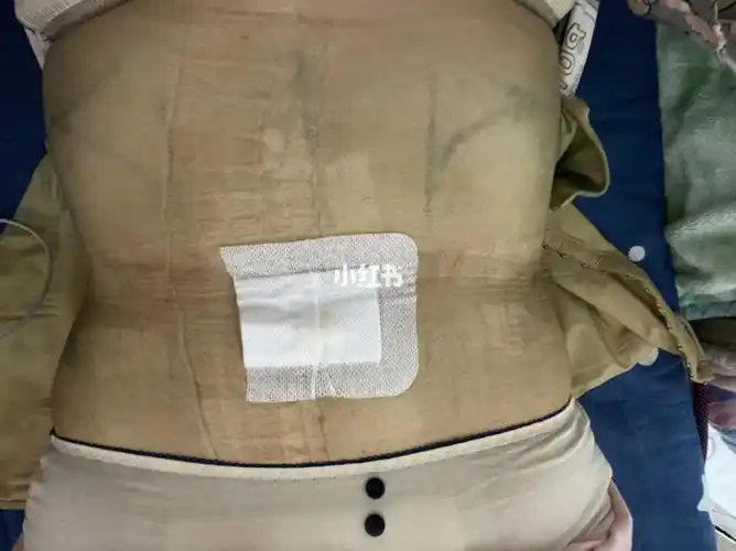 腰腹环吸第三天_腰腹_腰腹环吸_减肥_减肥医药