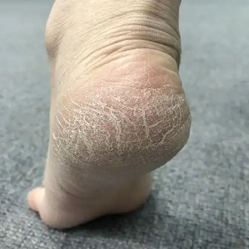 脚后跟,最典型的角质层堆积部位