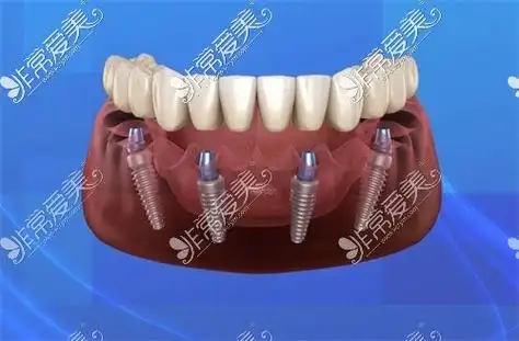 满口种植牙示意图