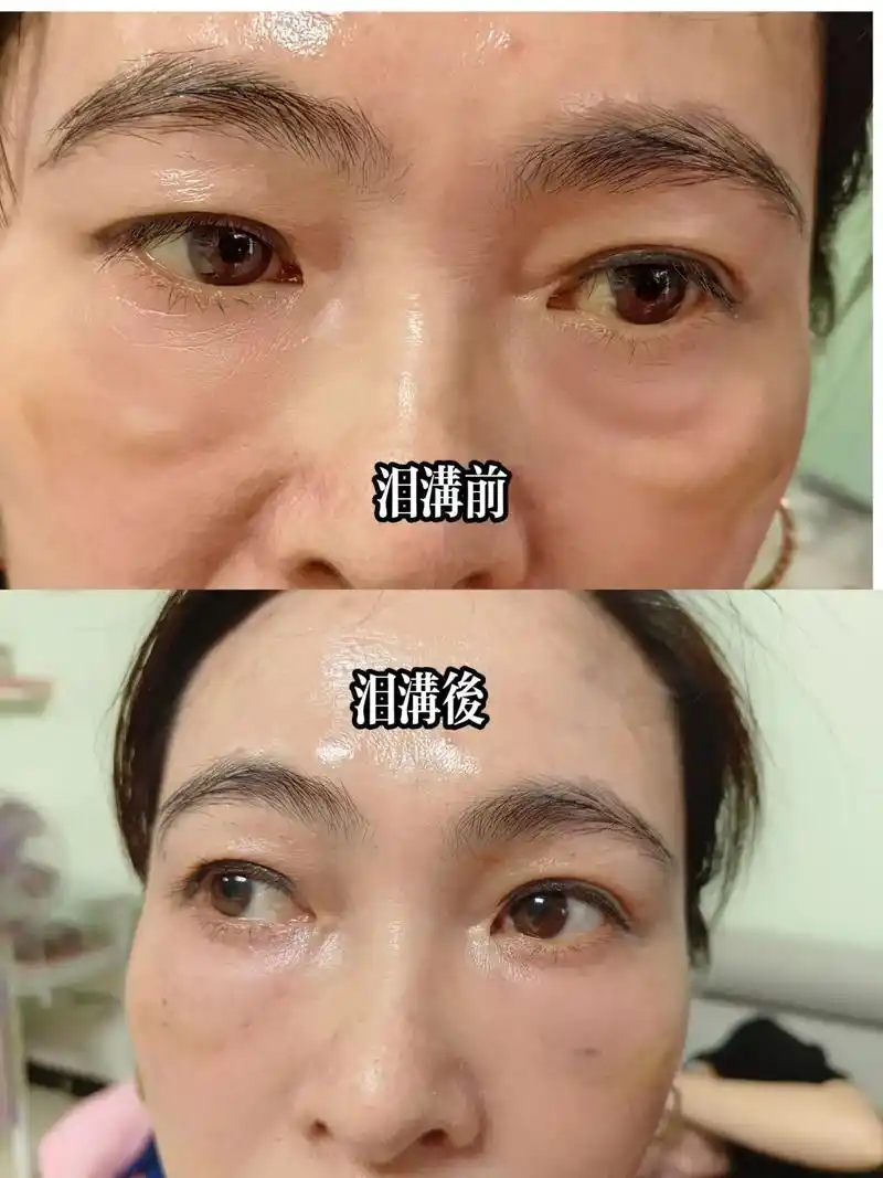 泪沟前后90对比 - 抖音