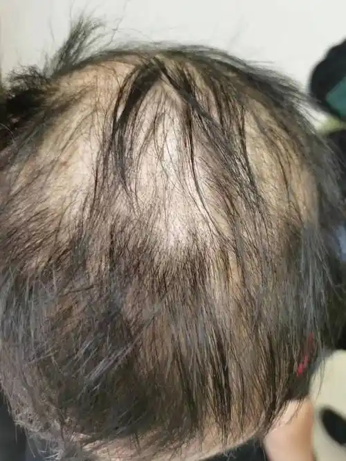 2个月前,他发现自己头发掉的有点多,但一想到自己还小,头发肯定会像