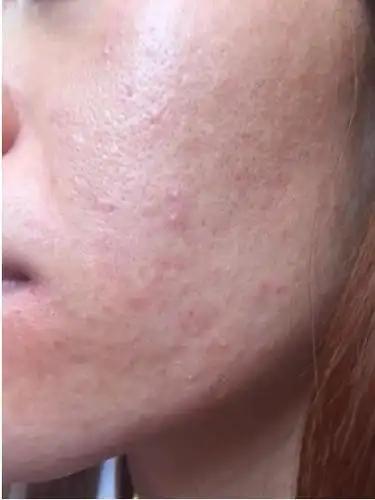 皮肤严重缺水时,脸部肌肤会发出5个"信号",看看你中招了吗?