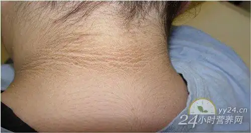 养生堂视频20130818三个细节稳血糖3糖尿病黑棘皮病三多一少排尿困难