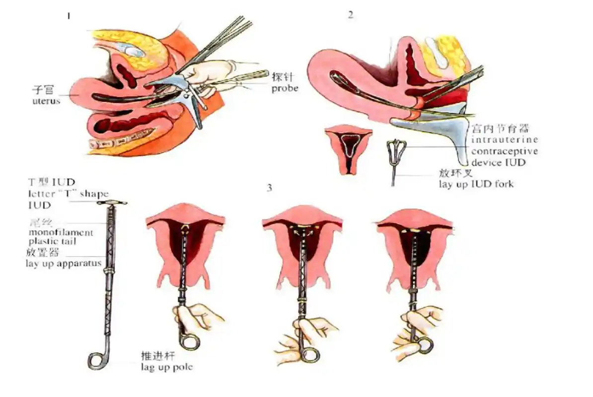 节育环也有保质期?出现"到期信号"定要取出,越拖伤害越大