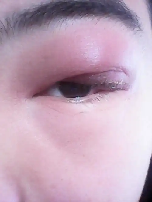 一觉醒来,眼睛就肿了,而且一直有眼屎出来