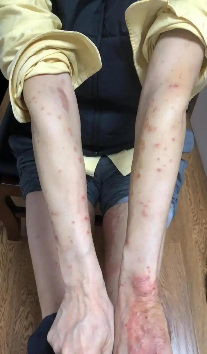 十年顽固性湿疹,大剂量应用附子后新发大量皮疹,中医治疗皮肤病不要