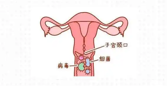 宫颈癌发出的第一个信号女性宫颈癌三个异常表现