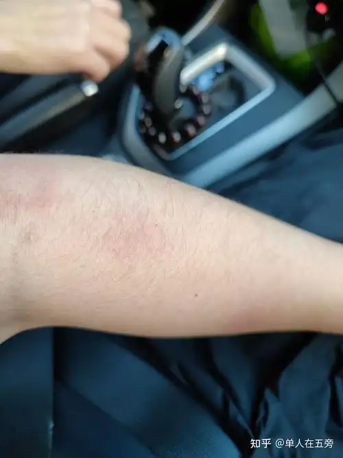 荨麻疹过敏性皮炎