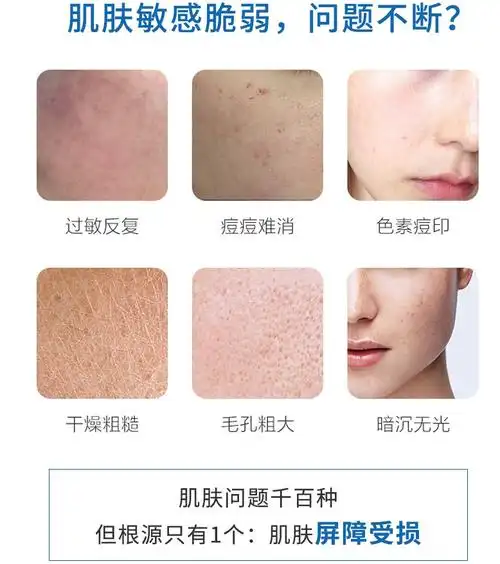 皮肤问题改善刻不容缓