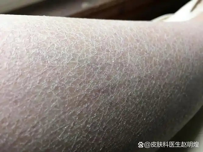 1 皮肤干燥:冬季气温低,空气湿度也相对较低,这使得皮肤容易干燥.