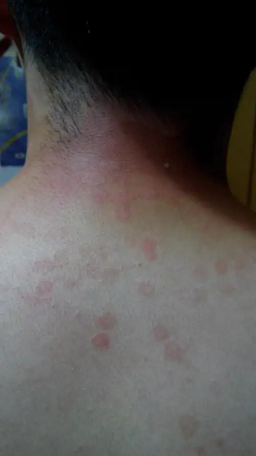 请问这是什么皮肤病,怎么治疗?(有图片)