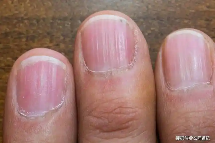 指甲有竖纹,就是不健康?这3个真相,一定要知道!_身体_反应_月牙