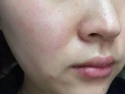 冬春换季皮肤干燥过敏保护敏感肌修复角质层要做好这几点