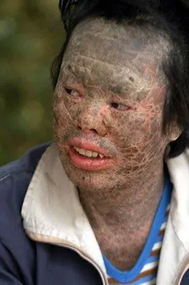 人类最罕见病变