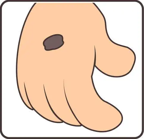 痣也可能会癌变长在3个地方要注意