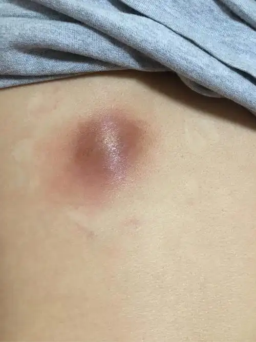 火疖子三厘米的火疖子现在还没化脓在涂鱼石脂软膏鱼