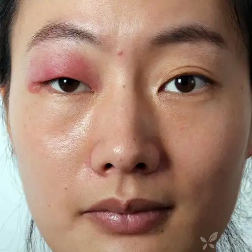 不明原因右上眼睑红肿半年 [病例帖]