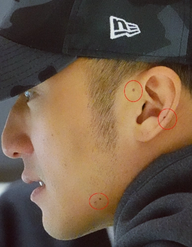 懒理与张柏芝复婚传闻,谢霆锋近照曝光脸部斑痣明显,曾患皮肤癌手术