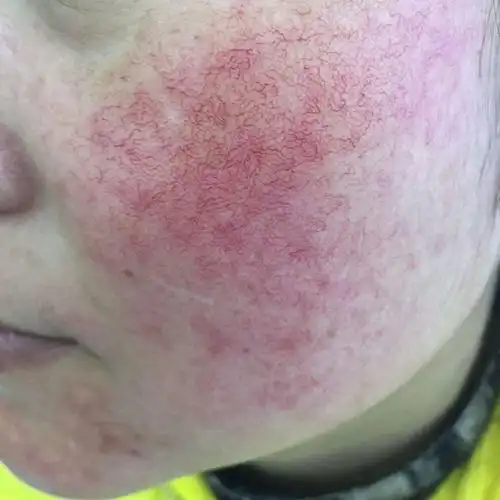 冷热水洗脸小心红血丝来袭!