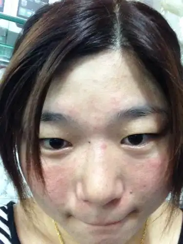 问:皮肤发痒,发红.上次医生说过敏,吃药也没有效果,谢谢