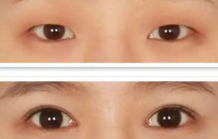运城丽都双眼皮对比图