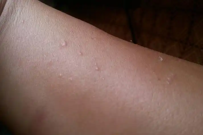 长扁平疣图手臂长扁平疣轻微的症状为米粒至黄豆大小的扁平隆起性丘疹