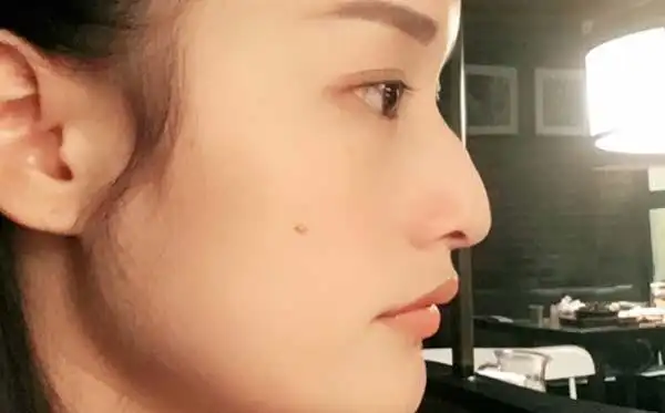 驼峰鼻手术都有哪些优点?