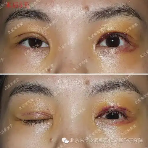 上睑下垂案例2015年8月18日b顾客术前术后1年对比
